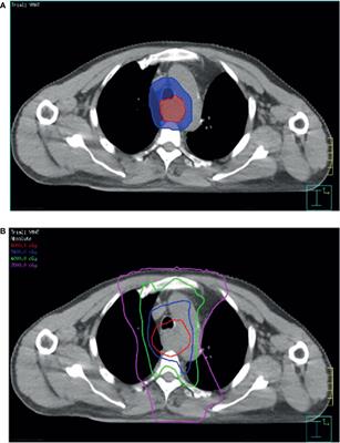 Combination of 35-Gene Mutation Profile and Radiotherapy Dosimetry Predicts the Therapeutic Outcome of Definitive Chemoradiation in Patients With Esophageal Squamous Cell Carcinoma